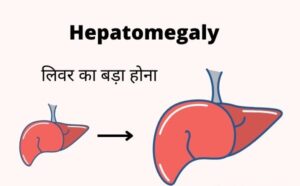 Hepatomegaly meaning in Hindi