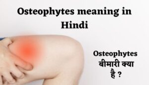 Osteophytes meaning in Hindi | अर्थ, मतलब और परिभाषा